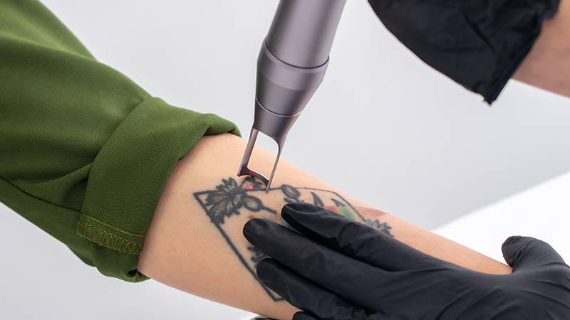 Eliminar un tatuaje